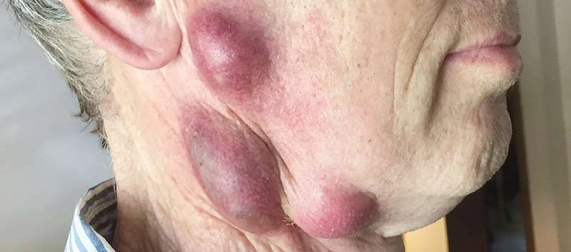 An overview of effective tularemia treatment options