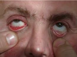 Swollen lymph nodes characteristic of glandular tularemia