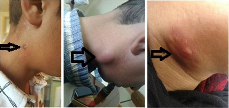 A micrograph of the bacterium Francisella tularensis