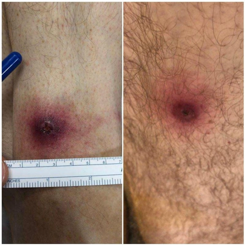 Vectors responsible for tick and deer fly fever