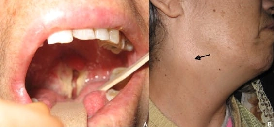 The transmission cycle of rabbit fever in wildlife