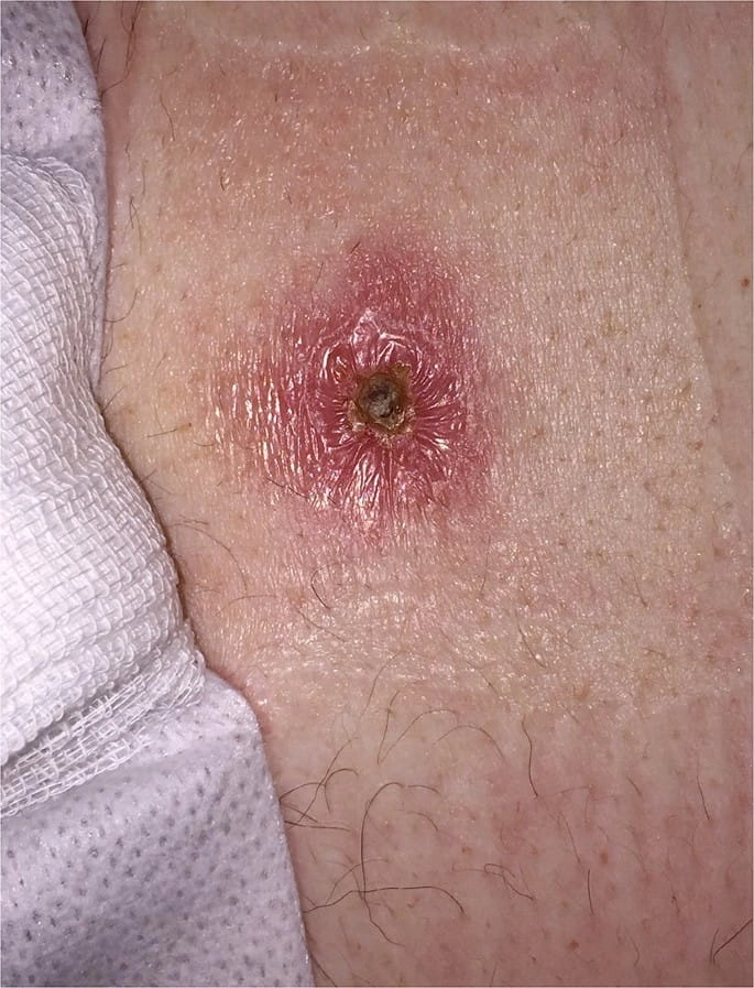 Learning how do you get tularemia from the environment