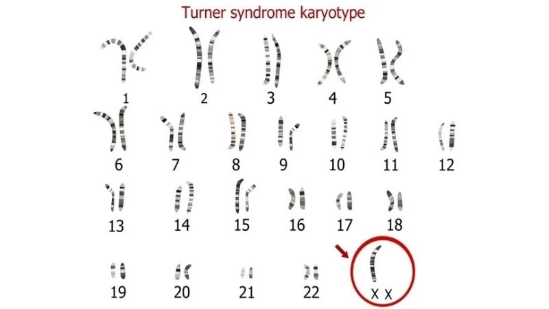 Coarctation of the aorta Turner syndrome cases