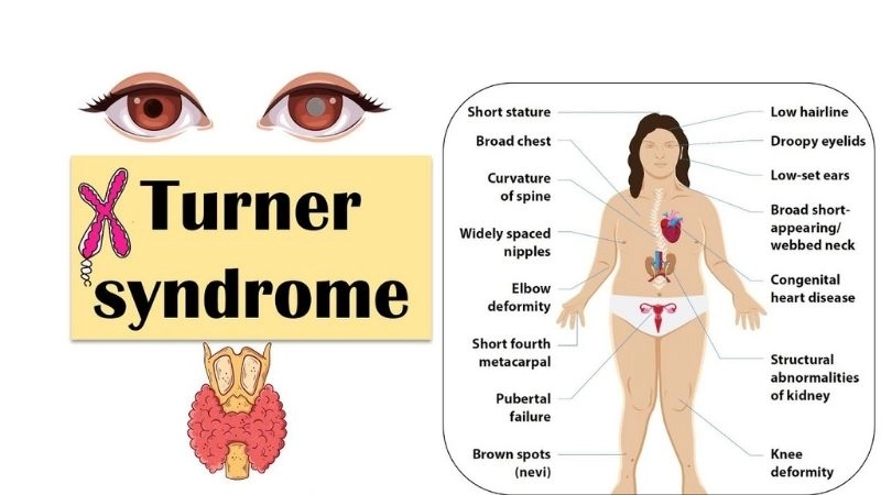 Turner syndrome aortic dissection risk factors