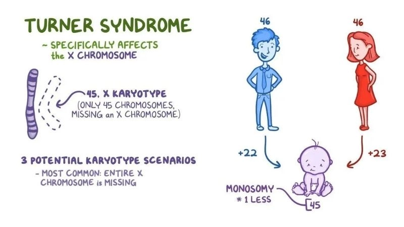 Turner syndrome cardiovascular complications overview