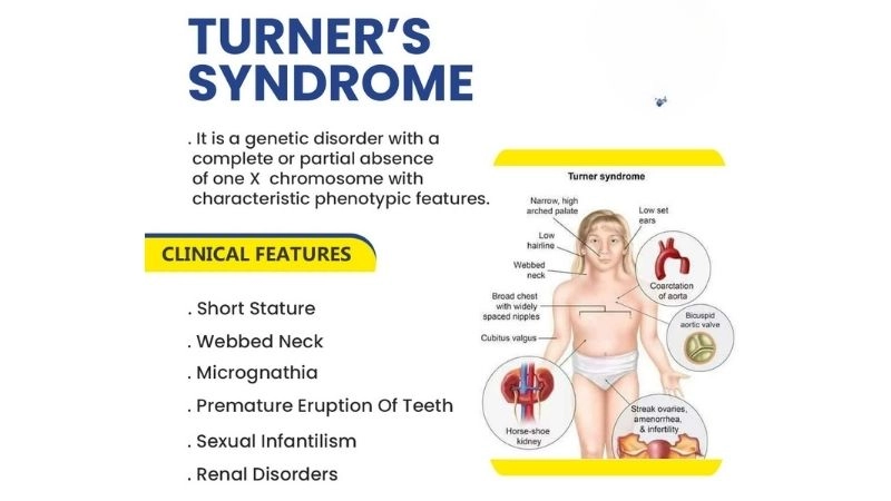 Turner syndrome cardiac screening importance