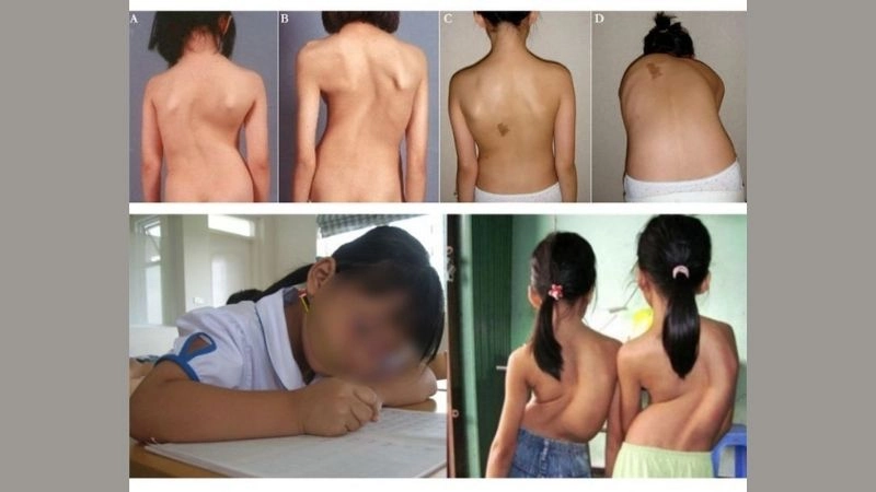 Turner syndrome heart failure understanding