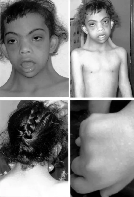 What is turner syndrome and its medical definition