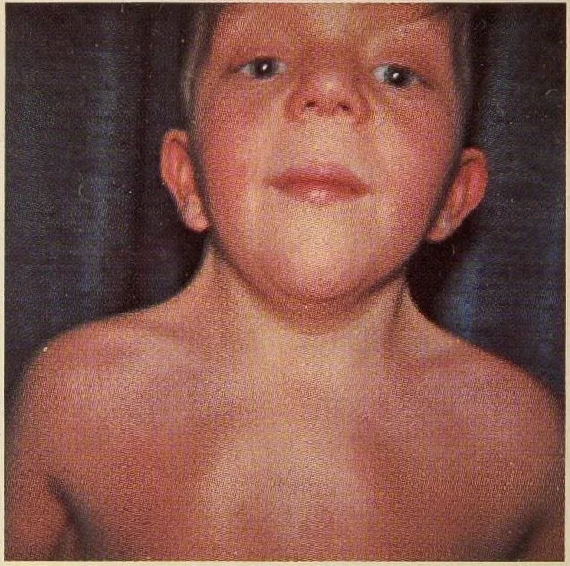 Mosaic turner syndrome with genetic variations