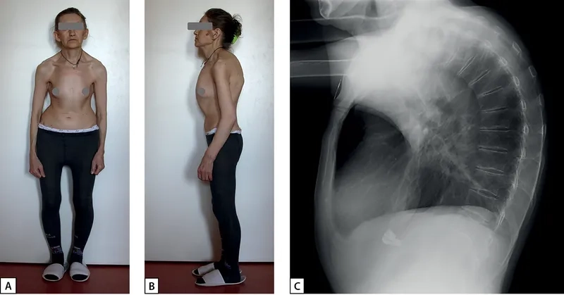 Turner syndrome karyotype and chromosomal pattern
