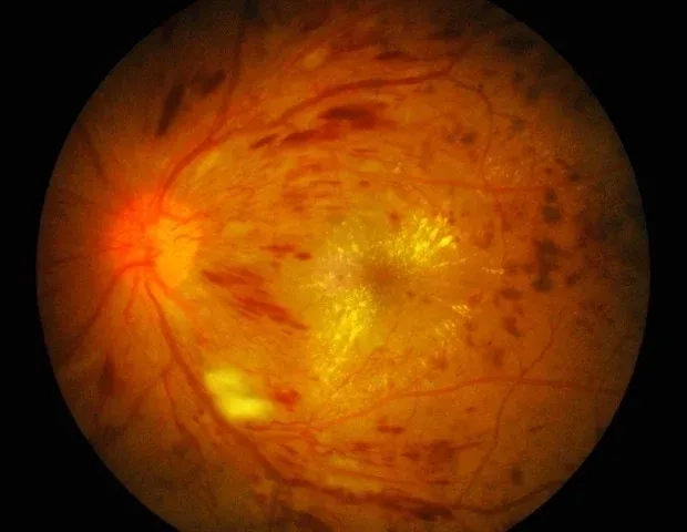 Risk factors linked to prediabetes