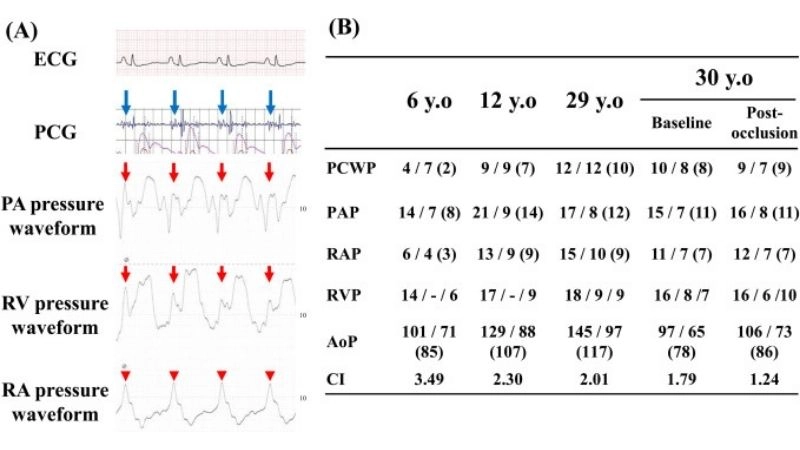 Congenital heart defect Uhl's Anomaly serious birth condition