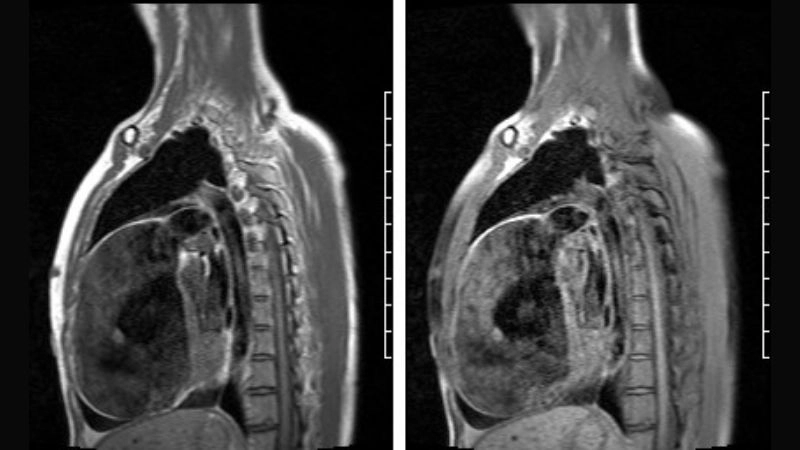 Uhl's Anomaly heart transplant lifesaving option for patients