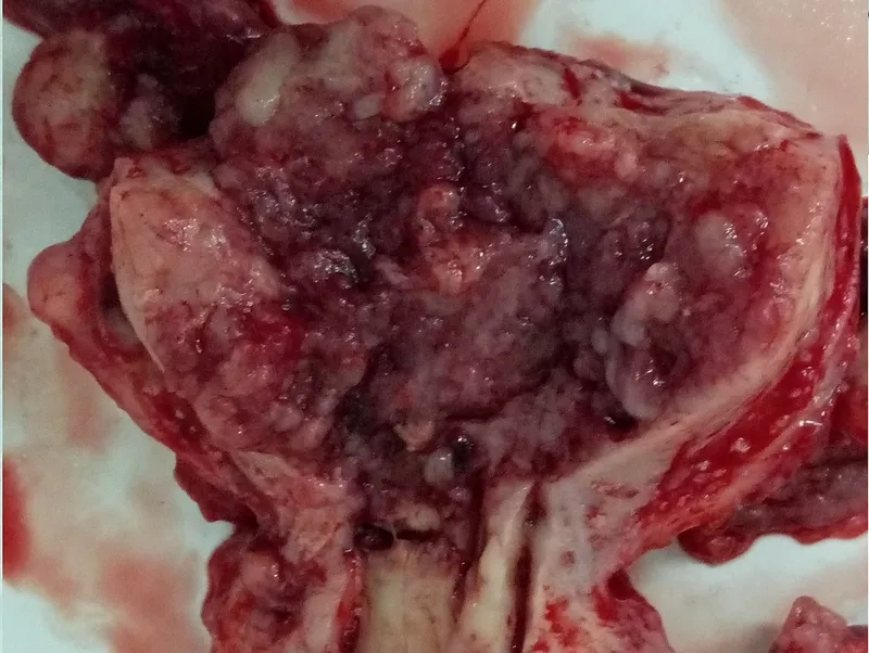 Illustrating endometrial cancer symptoms