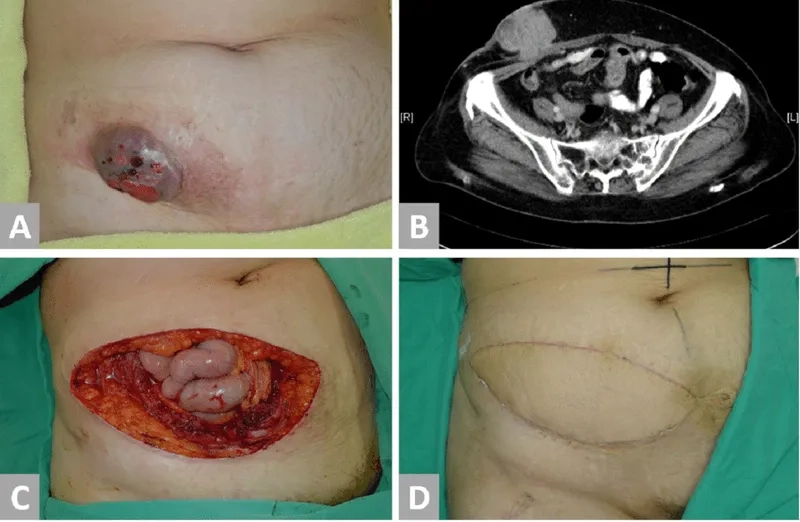 Doctor explaining uterine cancer