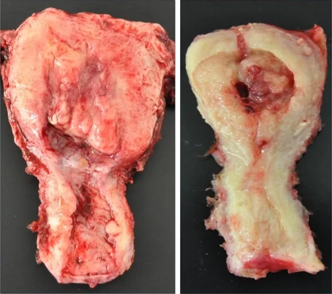 Patient receiving uterine cancer treatment