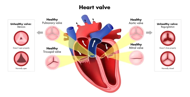 Heart diagram showing mitral valve regurgitation