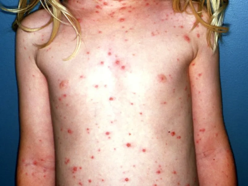 Timeline: how long is chickenpox contagious