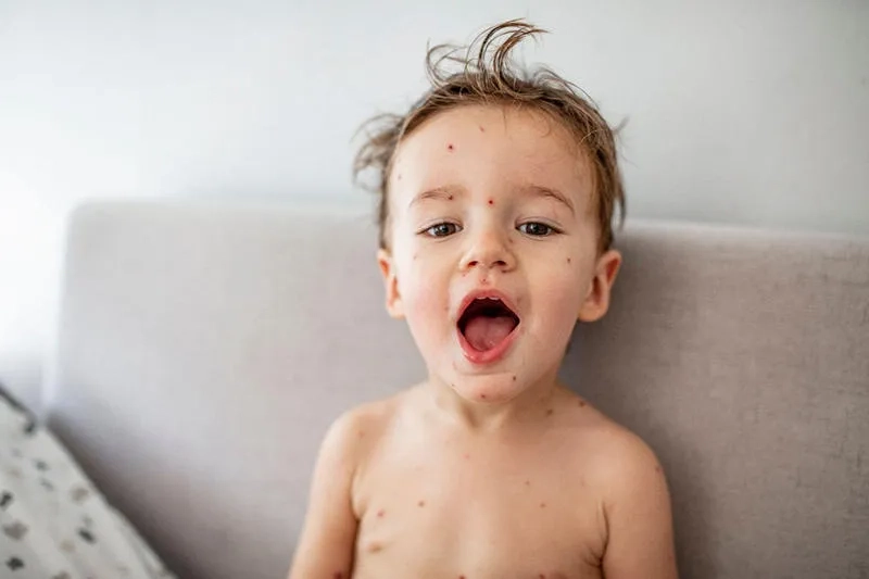 Identifying the early signs of chickenpox