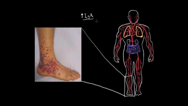 Illustration of giant cell arteritis affecting the head