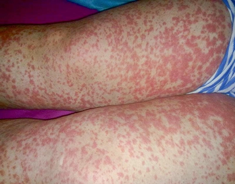 The typical appearance of a vasculitis rash