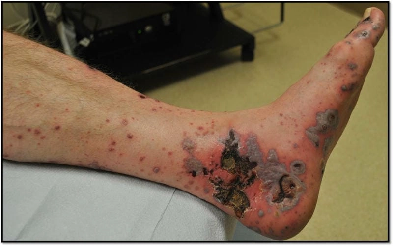 Understanding the mechanism of autoimmune vasculitis