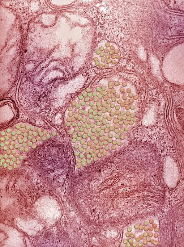 Recognizing Eastern Equine Encephalitis symptoms