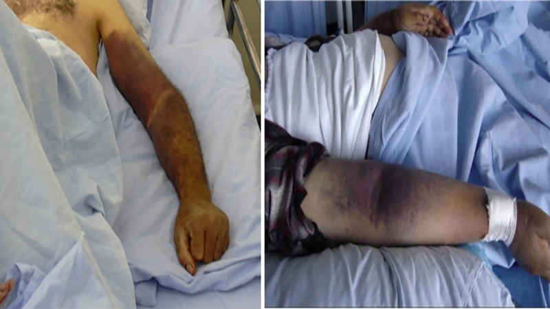 Venezuelan Hemorrhagic Fever and VHF diagnosis