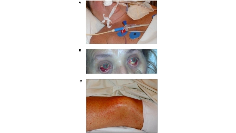 Venezuelan Hemorrhagic Fever spread by rodent host