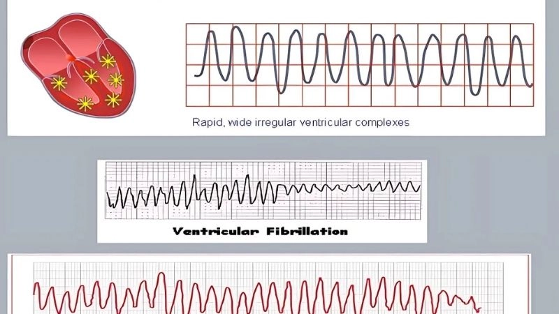 Coronary artery disease narrows arteries reducing blood flow