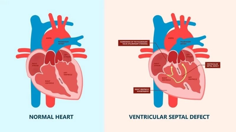 Ventricular septal defect treatment options to protect heart