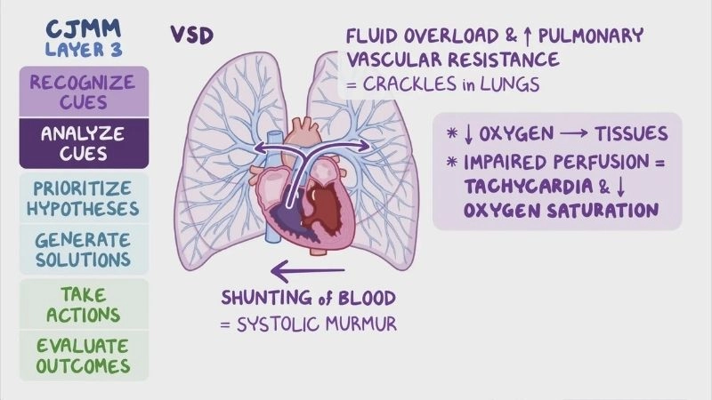 What is a ventricular septal defect understanding the condition