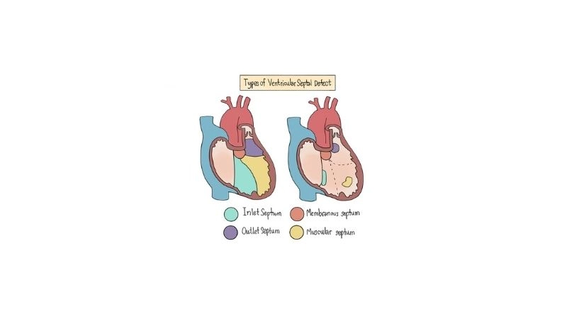 Causes of ventricular septal defect congenital heart formation issues