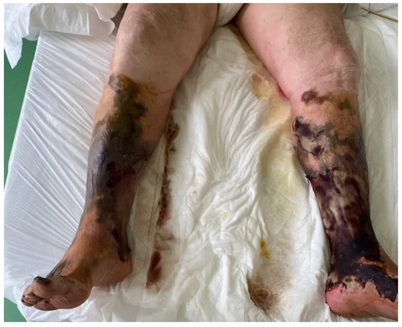 A severe infection caused by flesh-eating bacteria