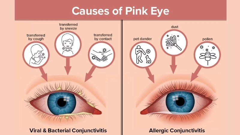 Viral Conjunctivitis Pink Eye treatment tips