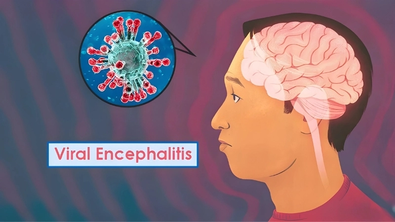 Herpes encephalitis requires urgent medical care