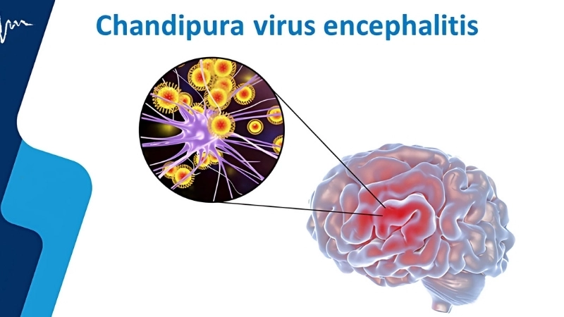 West Nile virus encephalitis affects the nervous system