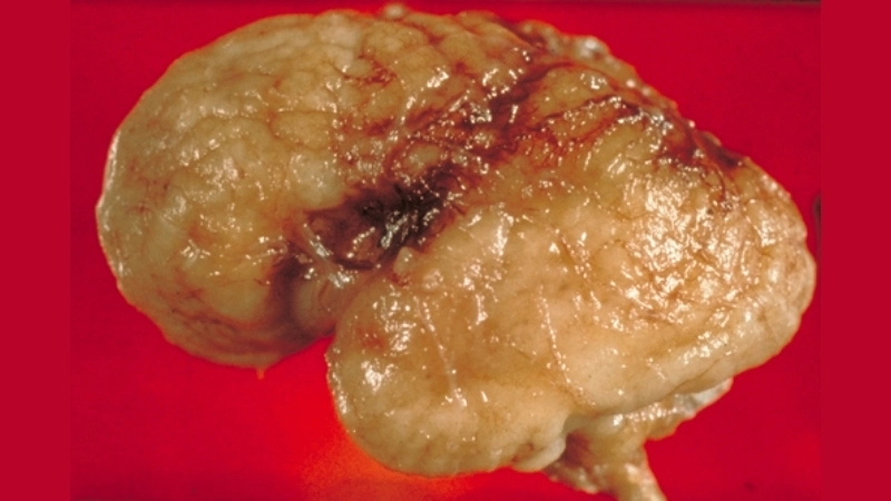 Encephalitis causes include virus infections and more