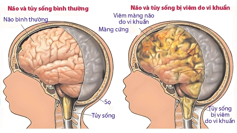 Learn if meningitis contagious and prevent it