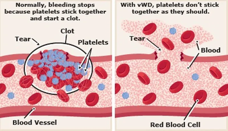 An overview of modern von willebrand disease treatment