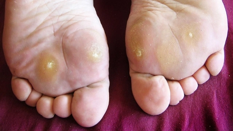 Warts common plantar genital molluscum contagiosum vs warts