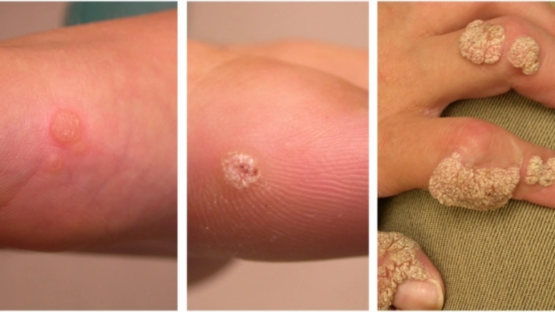 Warts common plantar genital plantar warts removal