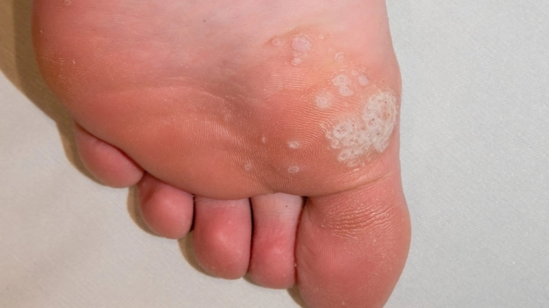 Warts common plantar genital genital warts causes