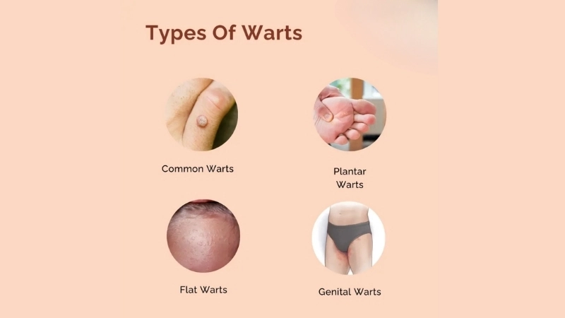 Warts common plantar genital with wart removal cream