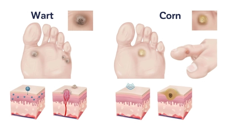 Warts common plantar genital with warts on face