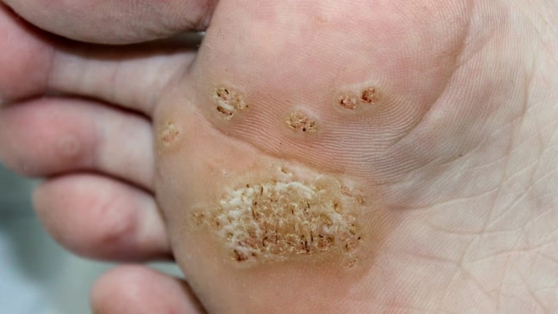 Warts common plantar genital flat warts treatment