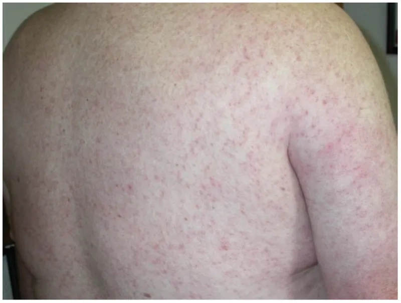 Identifying a West Nile Virus mosquito bite