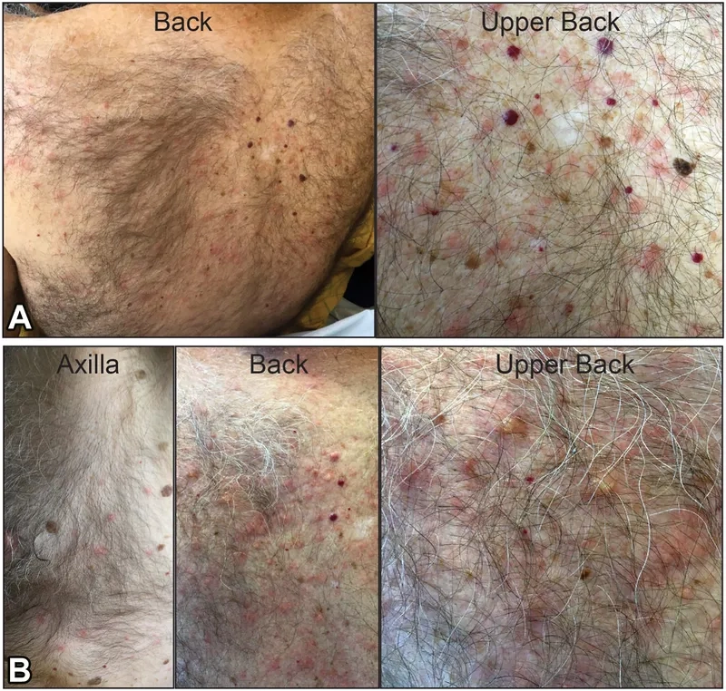 Supportive treatment for West Nile Virus