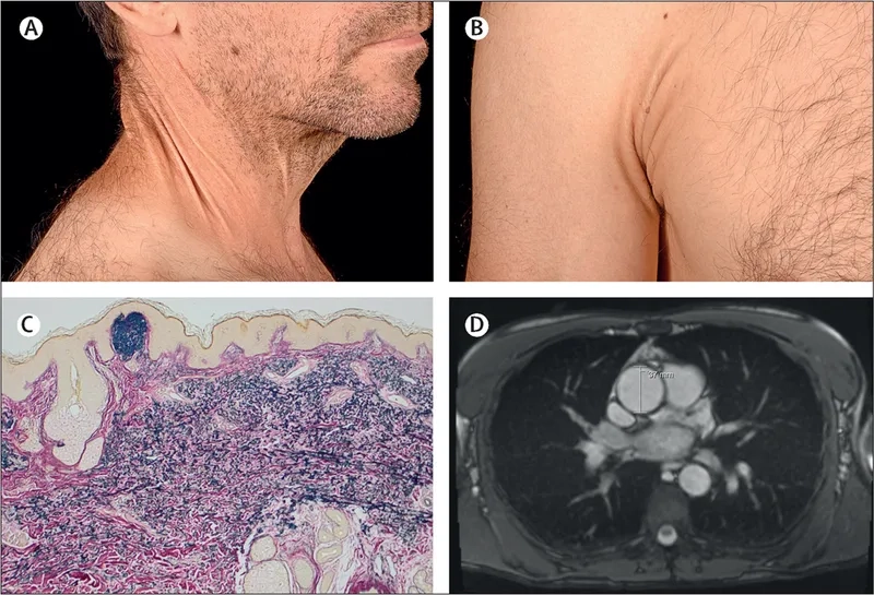 Prescription bottle of penicillamine medication