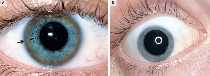 Wilson's disease symptoms affecting liver and brain